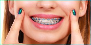 Dental-Bracess